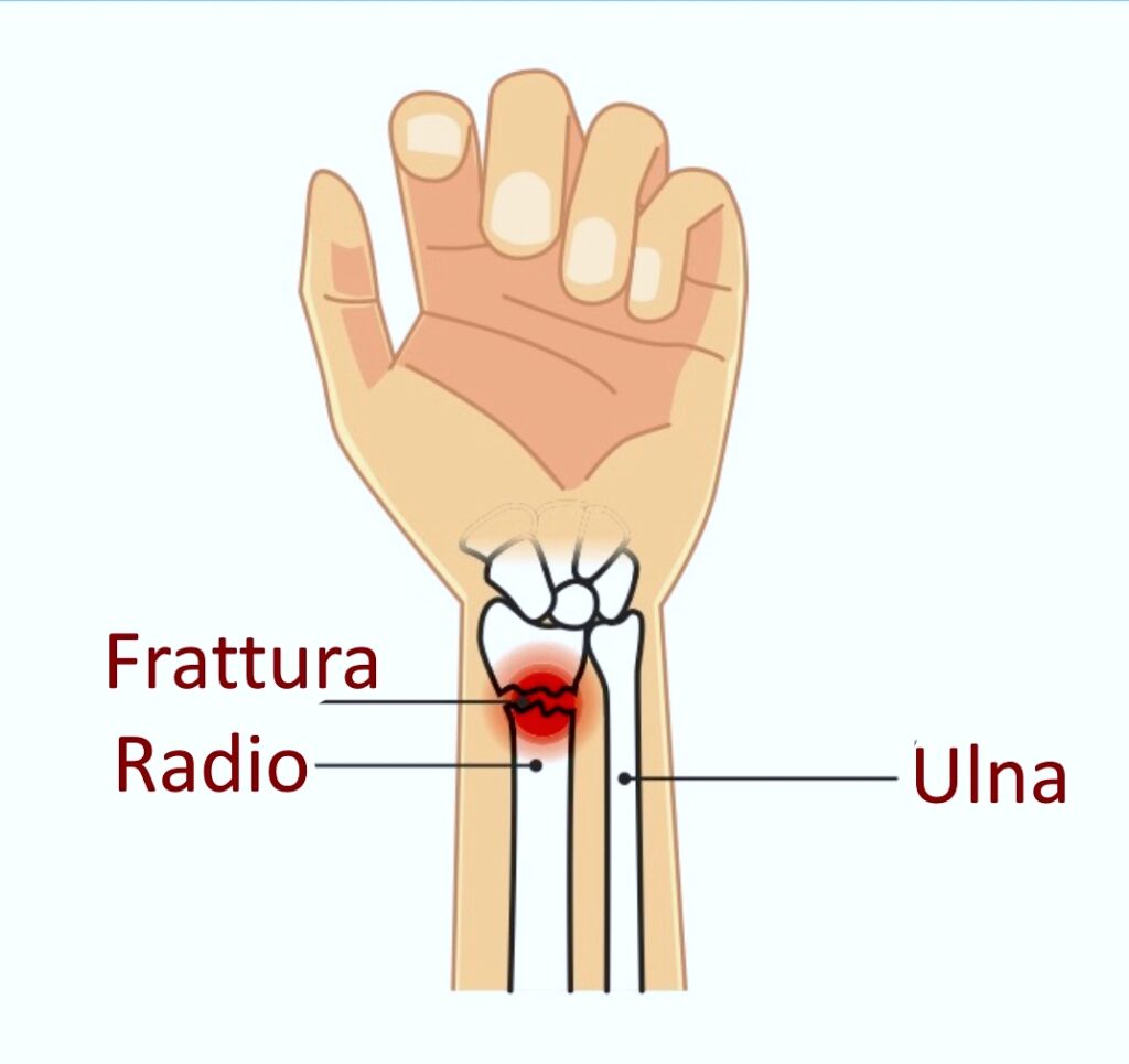 Different types of distal radius fractures seen in the hand therapy clinic 2022 11 20 18 04 53 1